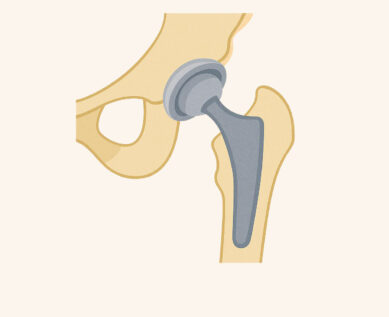 Image of Hip replacement