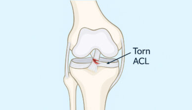 Ligament Tear